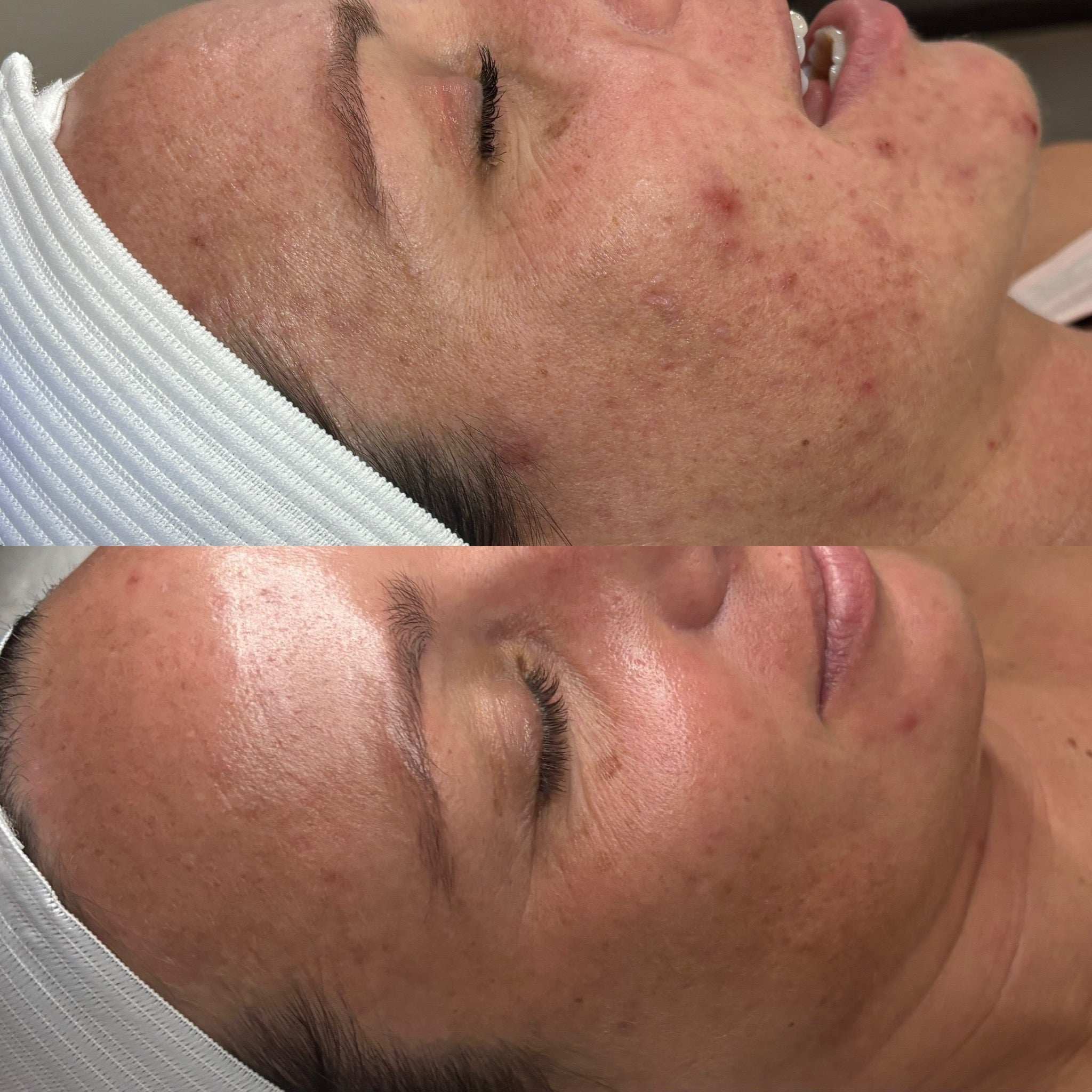 Acne Treatment That Actually Works | Skin Junkies Studio