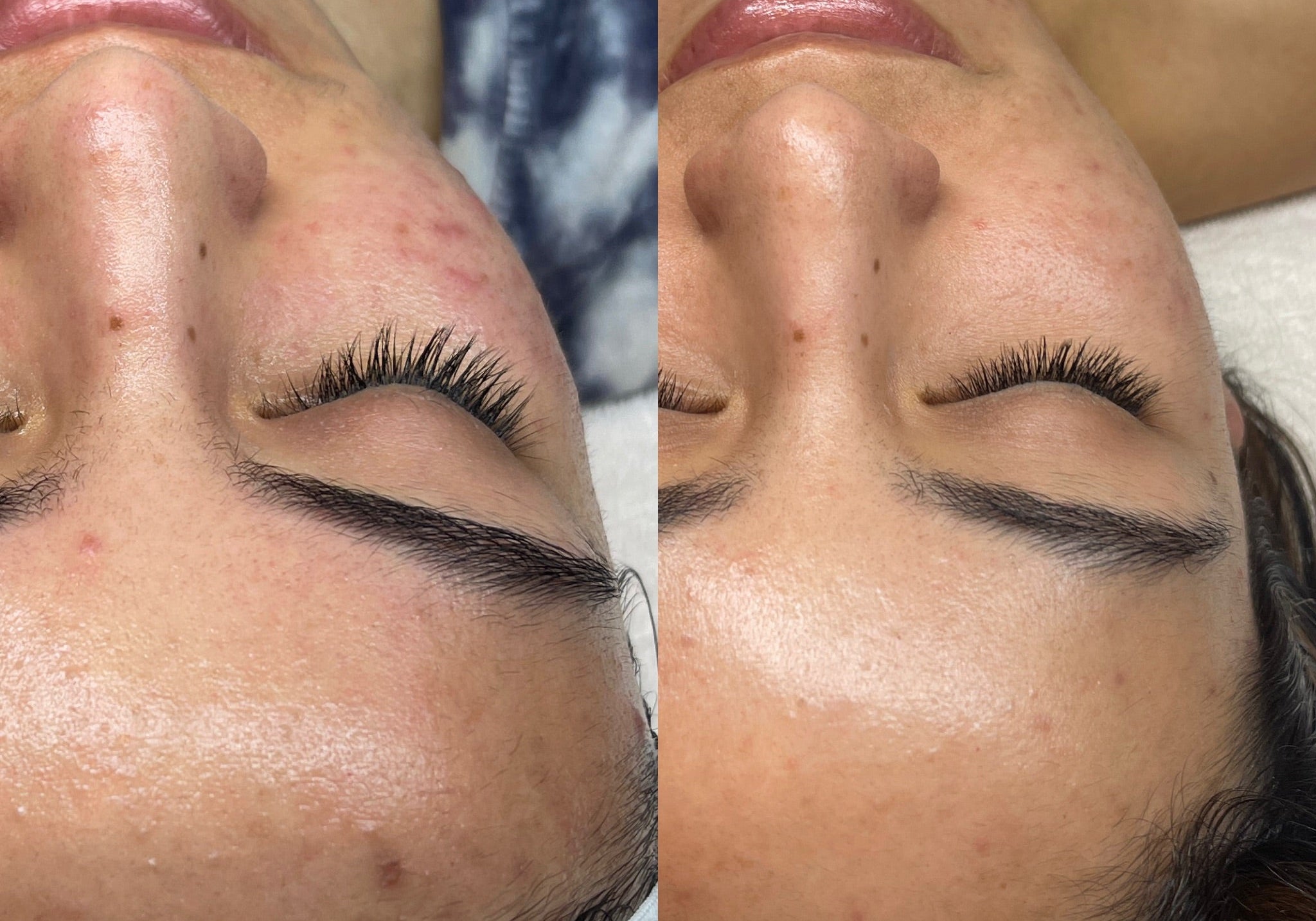 Acne in Your 20’s: Why It Happens & How to Treat It Without Overdoing It