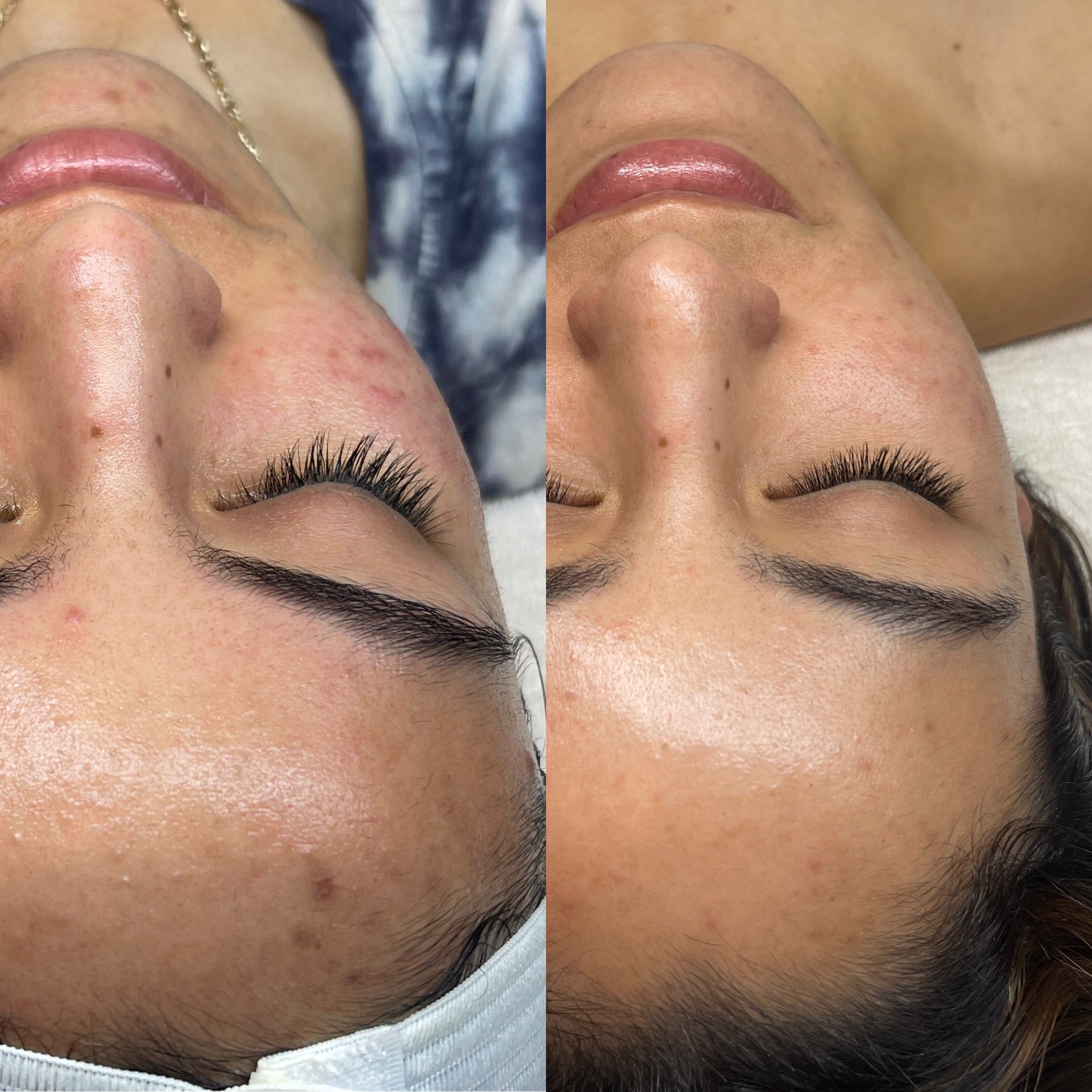 Acne in Your 20’s: Why It Happens & How to Treat It Without Overdoing It